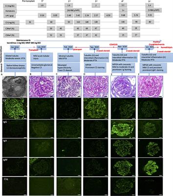 Case Report: Clinical and Pathological Findings of a Recurrent C3 Glomerulopathy With Superimposed Membranoproliferative Glomerulonephritis Pattern and Cryoglobulinemia Associated With COVID-19